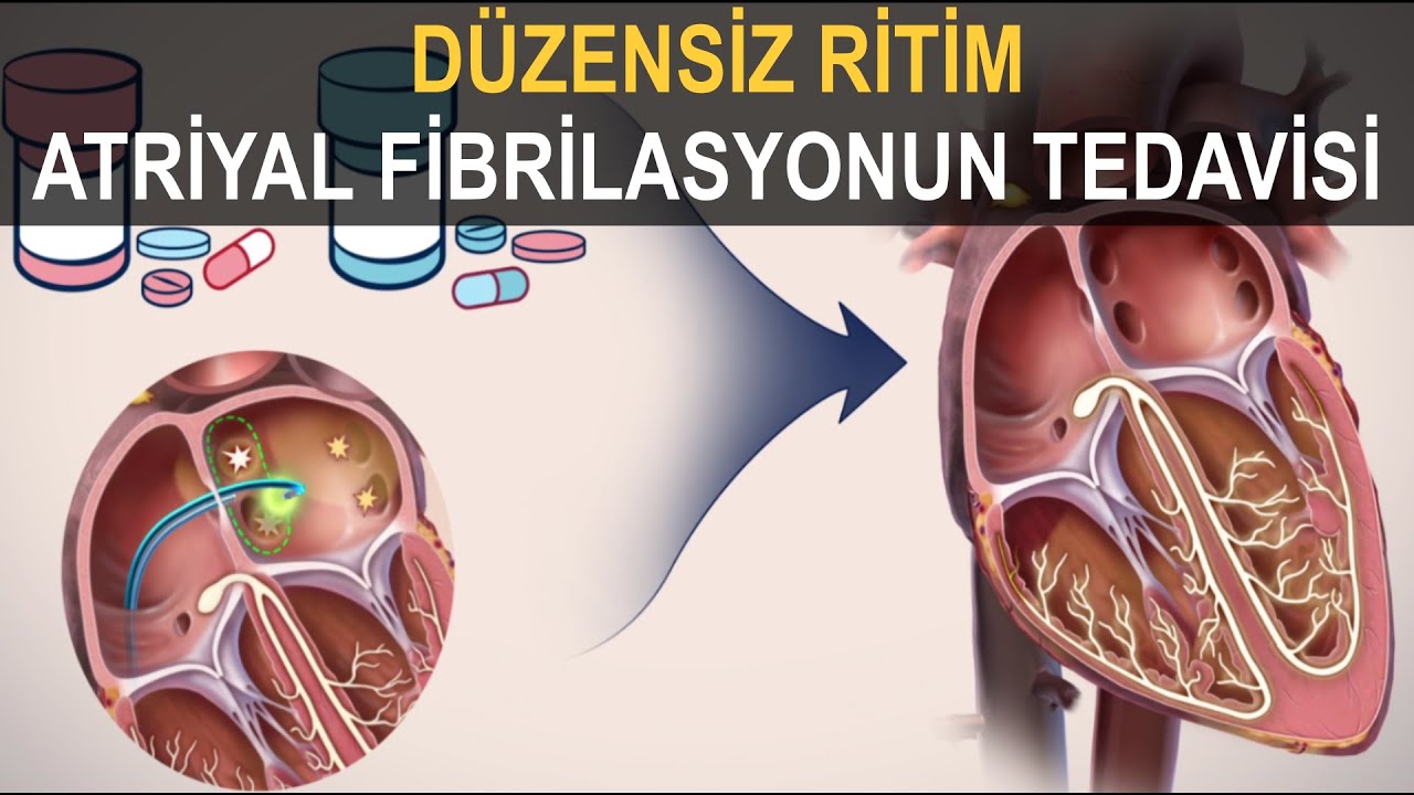 ATRİYAL FİBRİLASYON (AF) TEDAVİSİ | AF Ablasyonu Nasıl Yapılır?