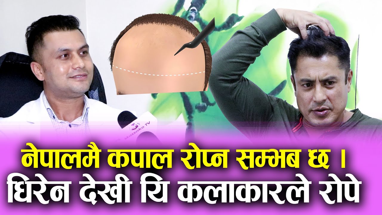 नेपालमै कपाल रोप्न सम्भब छ, Dhiren Shakya  देखी यि कलाकारले रोपे Hair Transplant Nepal