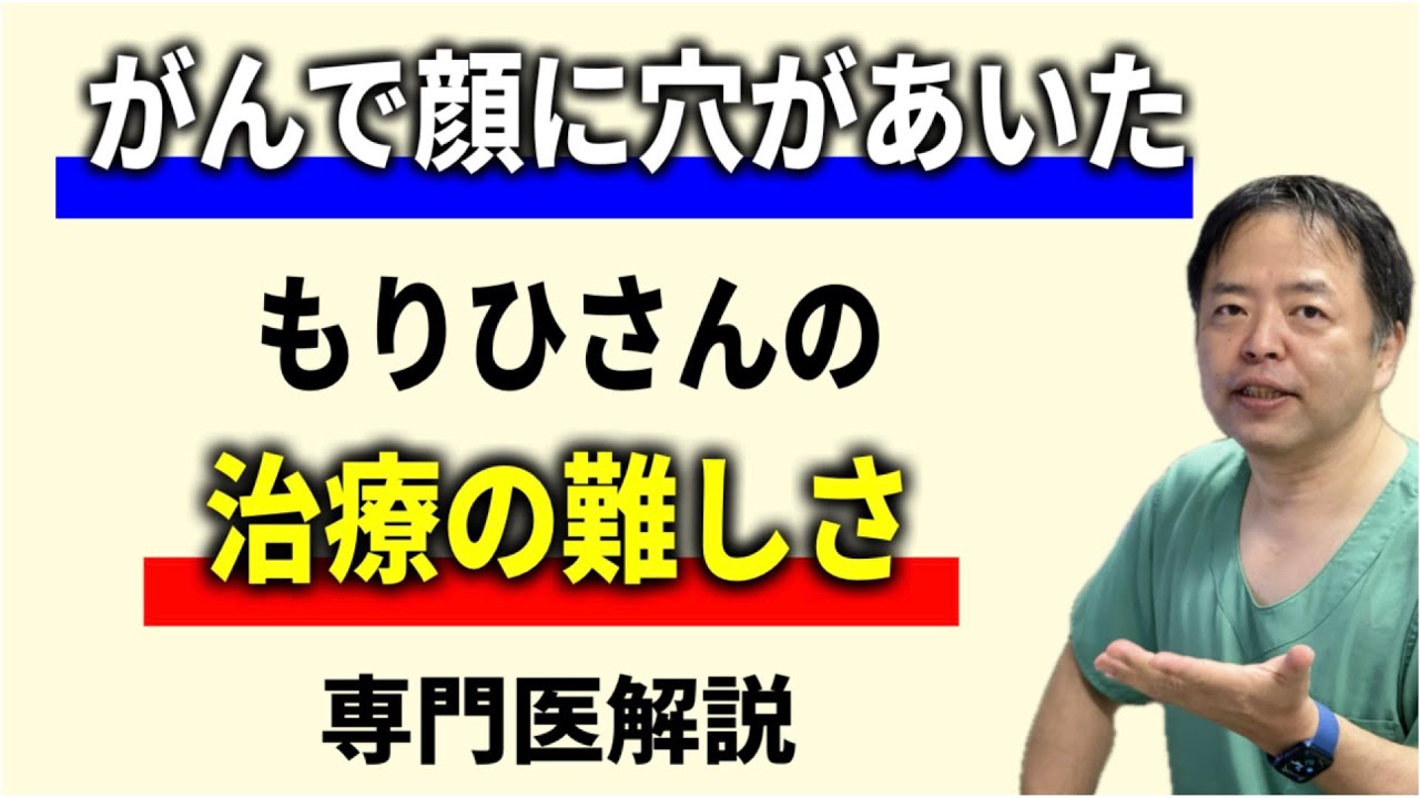 がんで顔に穴があいたもりひさんの治療の難しさ【専門医解説】有名人がん解説シリーズ