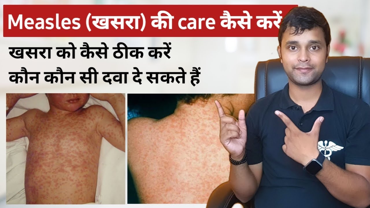 How to care for Measles in children | How to treat measles | Measles disease in Hindi | Measles disease