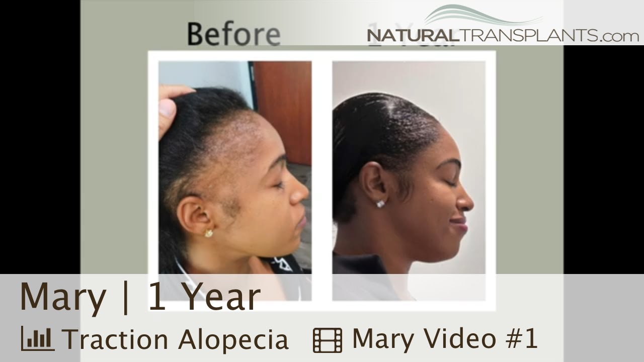 Turning Back the Clock for Traction Alopecia Patient Hairline! | Dr. Siegel (Mary)