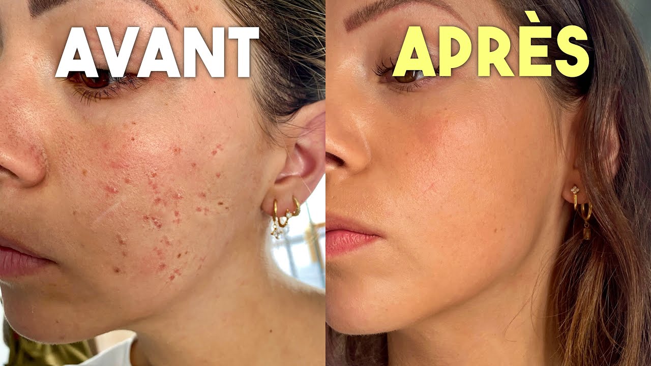 COMMENT JE ME SUIS D&Eacute;BARRASS&Eacute;E DES MICROKYSTES !