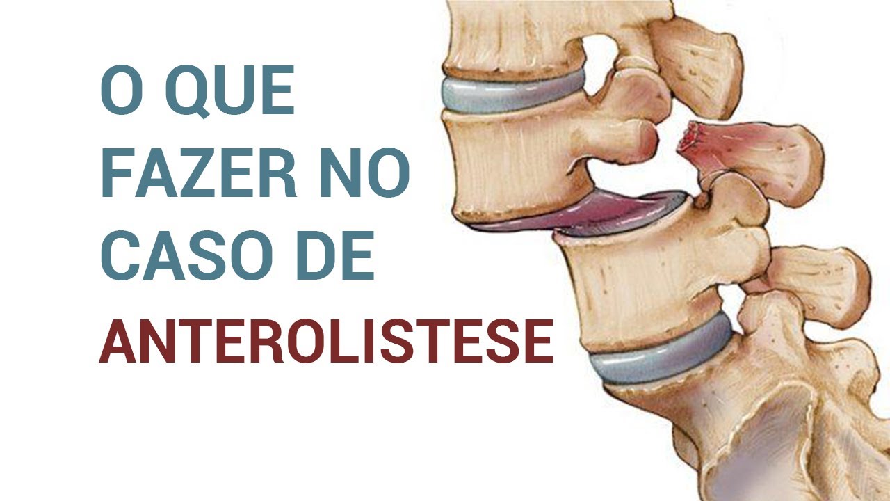 Que exercícios eu faço para anterolistese?