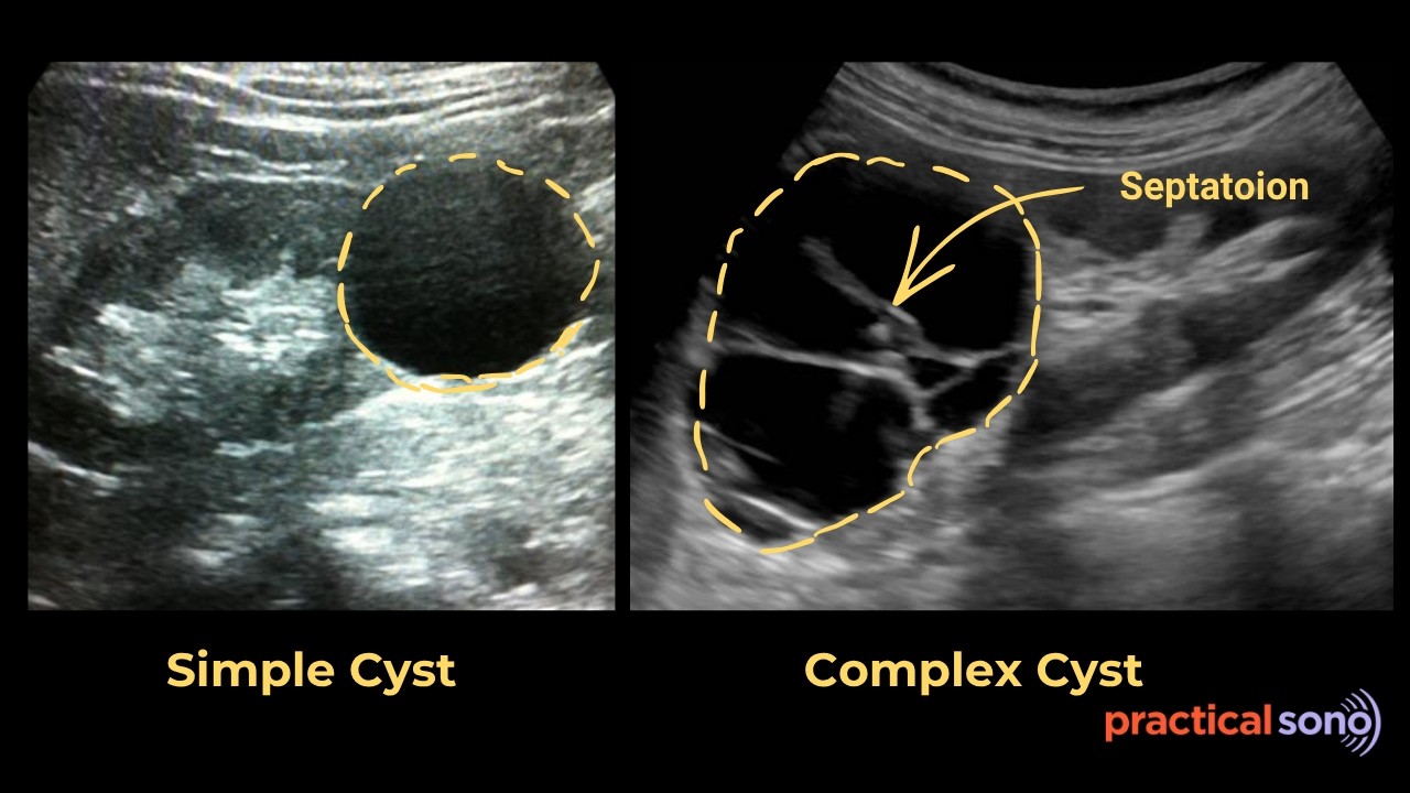 Simple vs Complex Renal Cyst Ultrasound | Ultrasound of Complex Renal Cystic Lesion