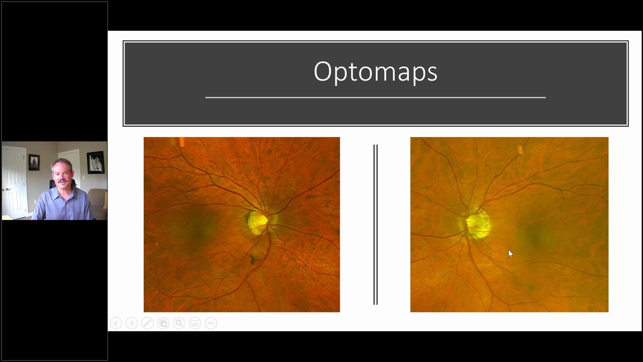 Using the RETeval ERG for Glaucoma w/ Dr. Mike Cymbor, OD