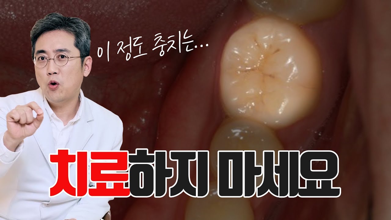 충치 치료때문에 고민이신 분들은 보세요!! 치과에서 바가지(?) 안 쓰는 법!! #충치치료 #초기충치 #신경치료