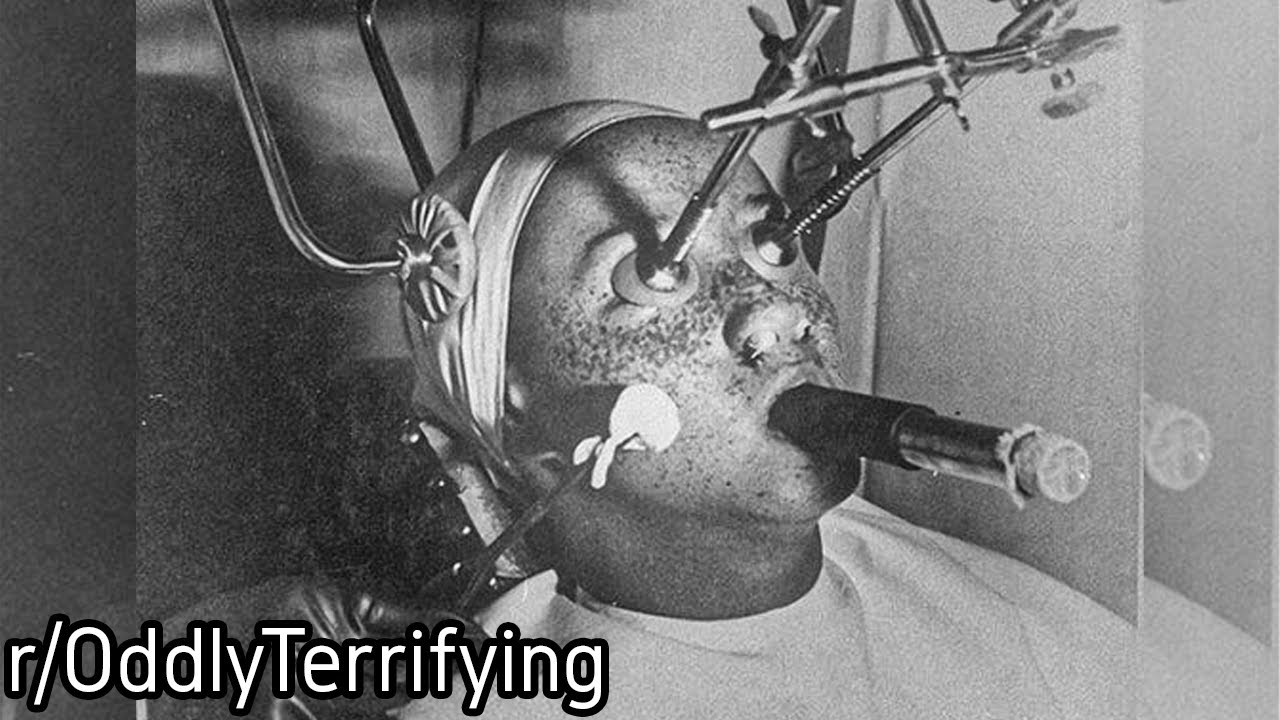 r/OddlyTerrifying | Old School Freckle removal Surgery...
