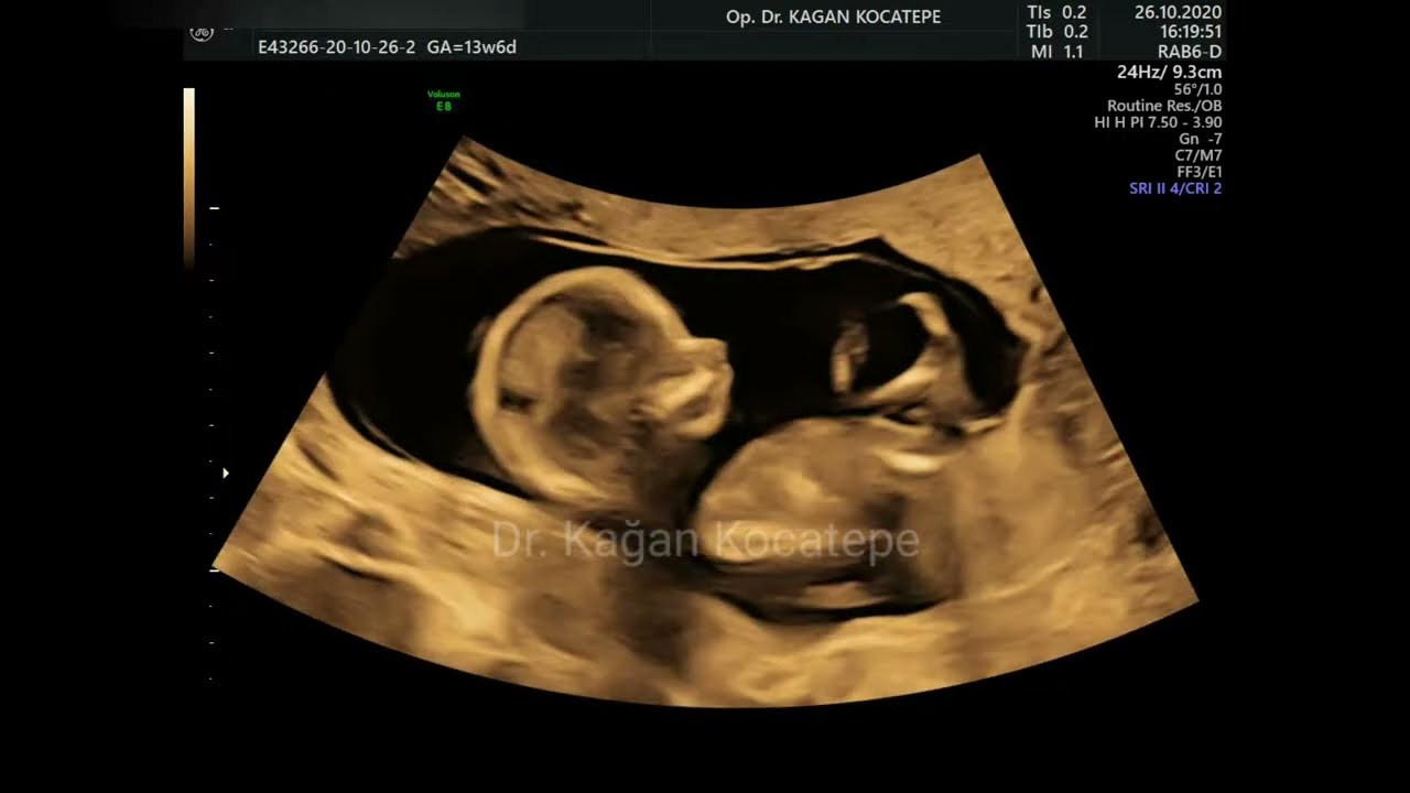 14. haftalık fetusun (3 aylık) cinsiyeti, ayrıntılı organ taraması, burun kemiği, ense kalınlığı