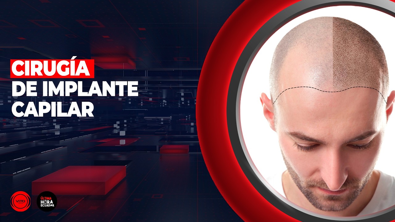Cirugía de implante capilar como alternativa para alopecia, cicatrices y secuelas por quemaduras