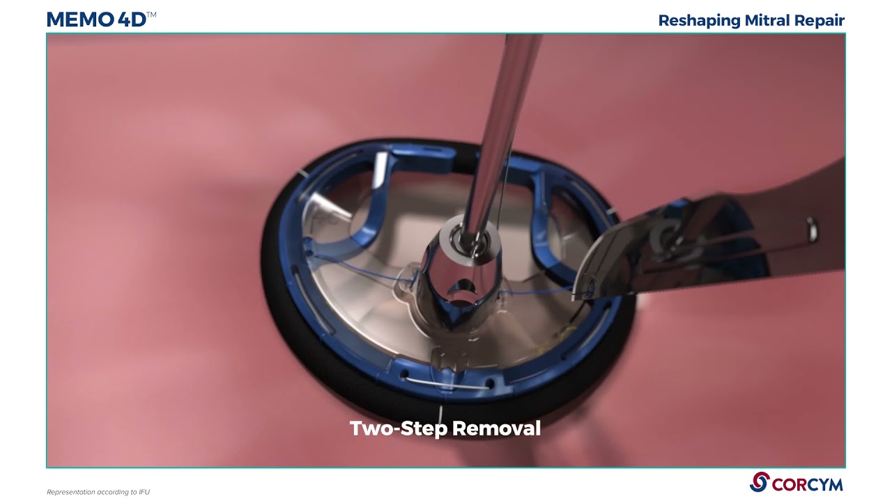 Mitral Ring Implantation Procedures – Animation