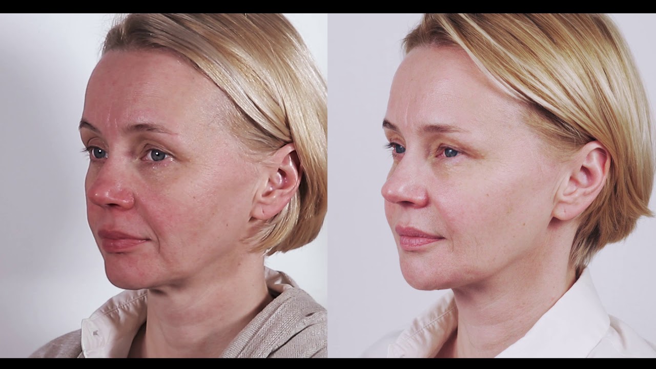 Nekirurški face lift tretman  (full face approach) - nevjerojatni rezultati