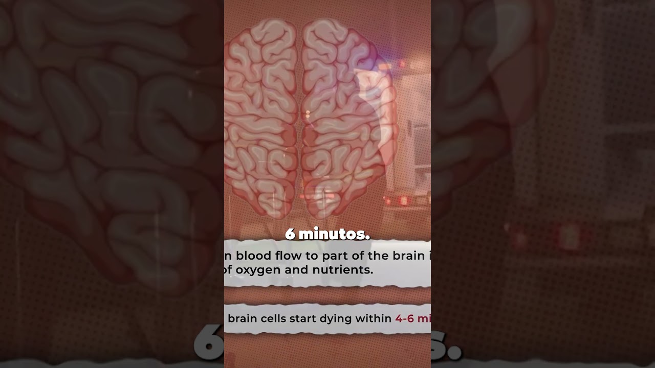 Derrame Cerebral: &iquest;cu&aacute;ndo ocurre?