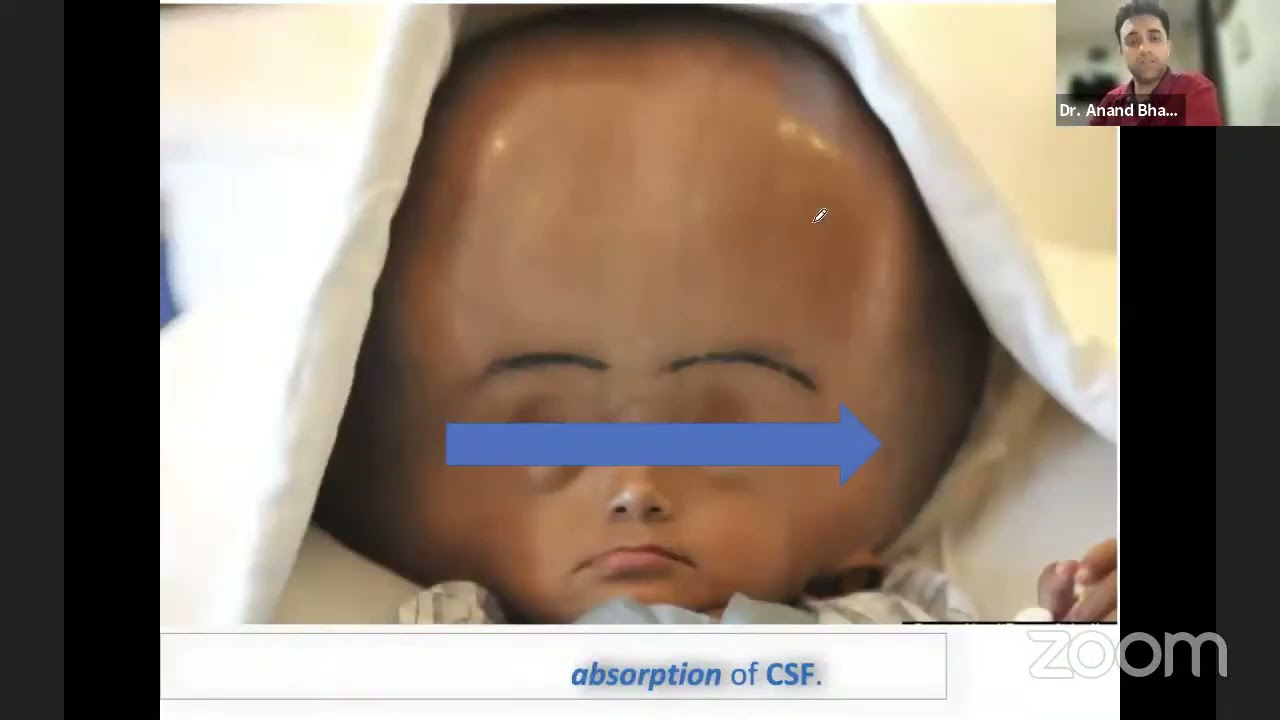 Hydrocephalus By Dr.Anand