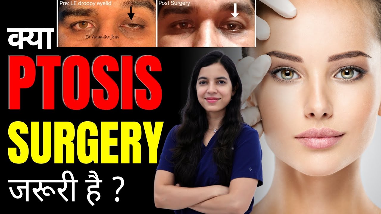 क्या ptosis surgery जरूरी है ? | Is ptosis surgery necessary? | Ptosis surgery | Dr Anamika Joshi