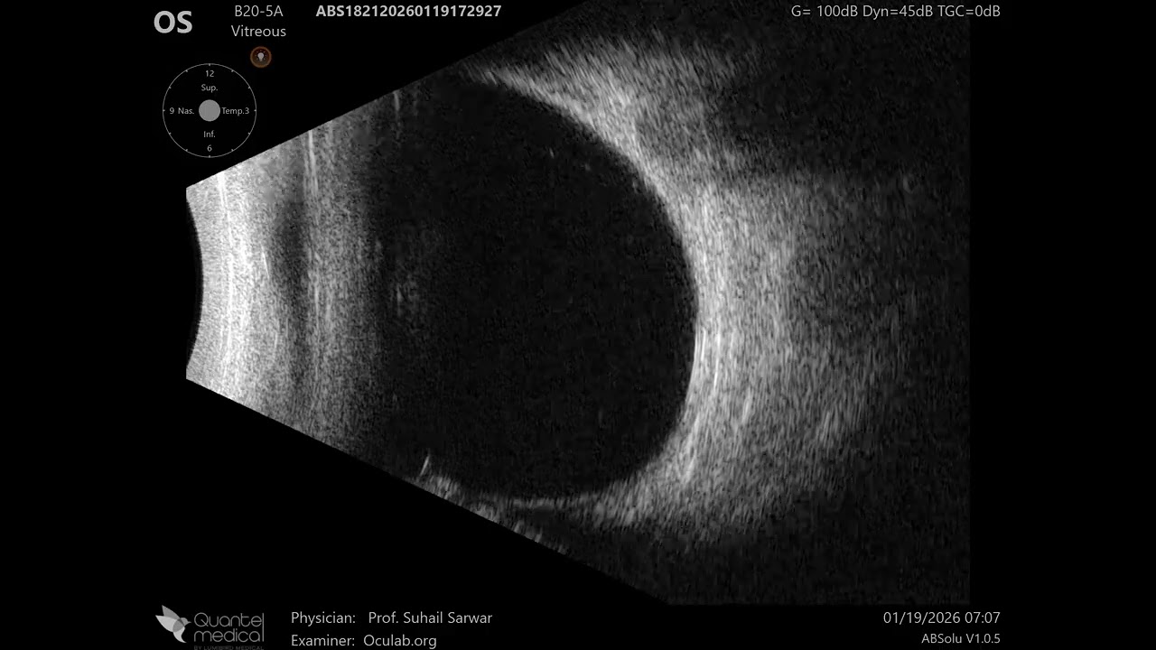 20 MHz Annular Ophthalmic Ultrasound ABSolu, Normal tomographs , 36931