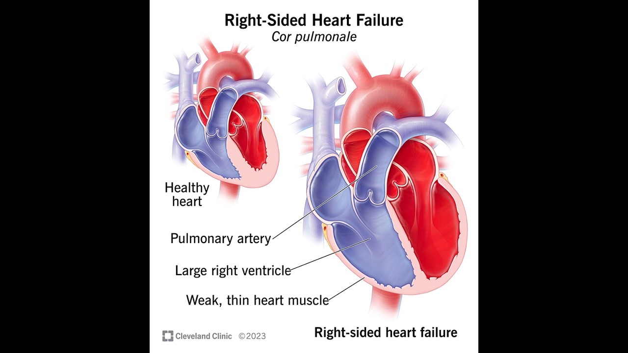 Right sided heart faliure USMLE/Pediatrics Boards