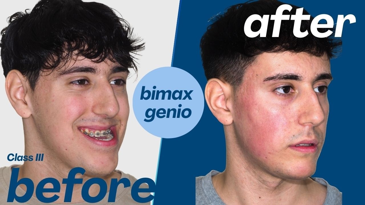 Bimaxillary Surgery Case #184 - Alex: Severe class III, Maxillary hypoplasia, Open bite