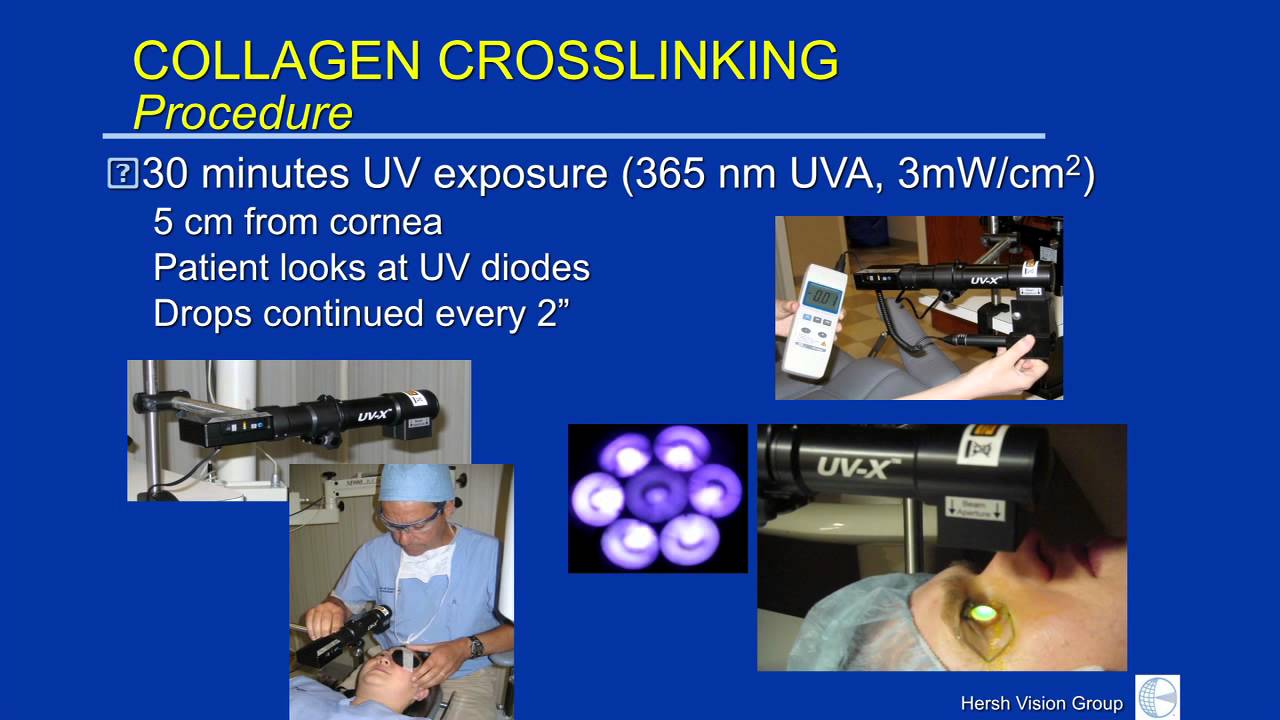Corneal Collagen Crosslinking Peter Hersh, MD