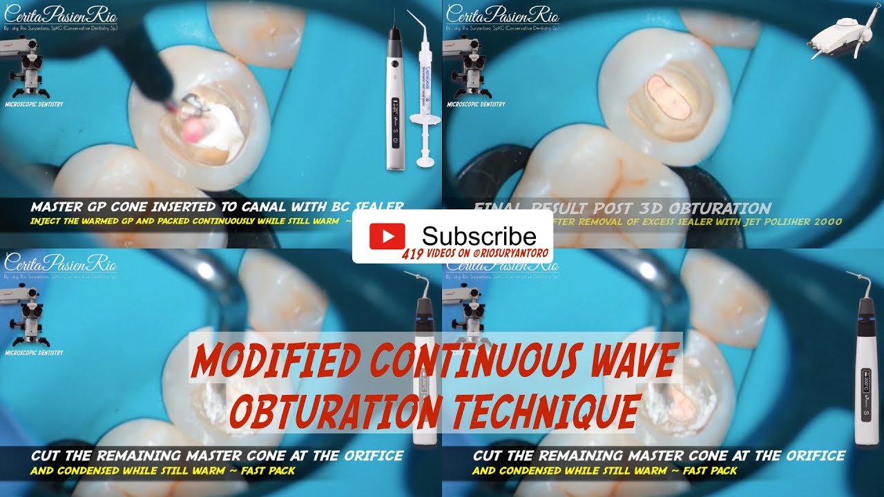 modified continuous wave obturation technique bioceramic sealer fast fill fast pack eighteeth