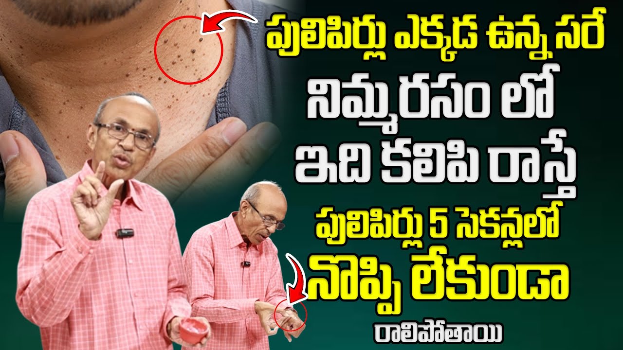 నొప్పి లేకుండా పులిపిర్లు మాయం | Instantly Remove Warts | Remedies For Pulipirlu