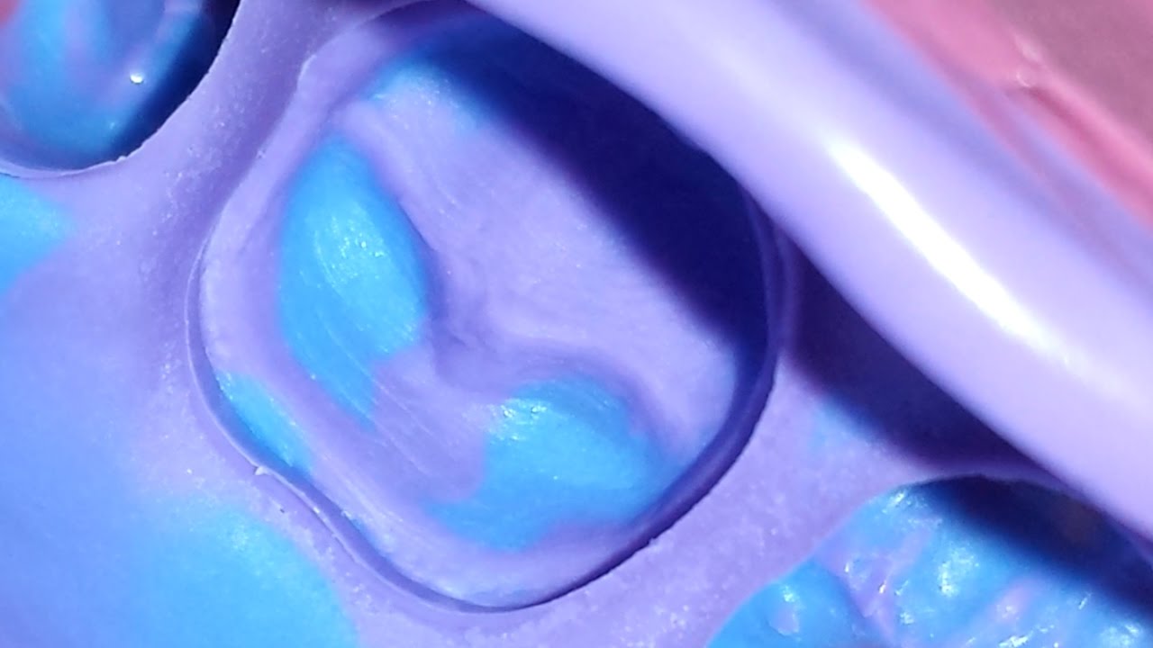 More Predictable Triple Tray Impression Technique using Light, Medium and Putty PVS