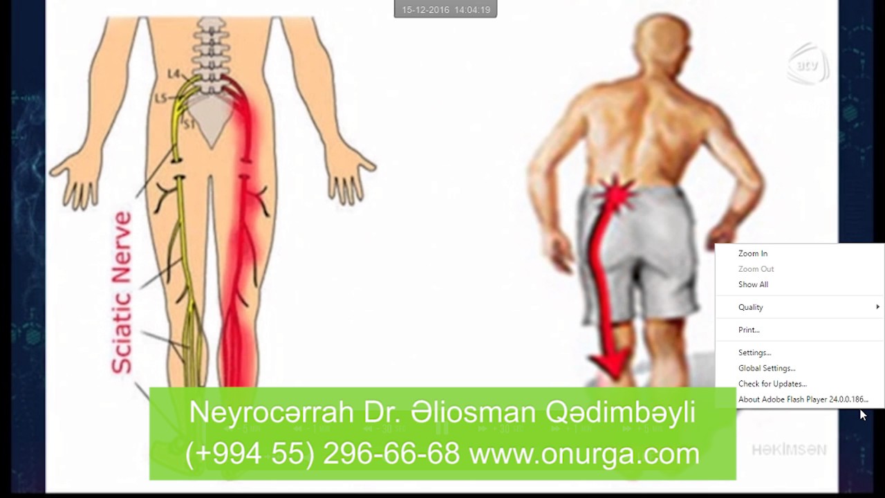 Bel disk yırtığı (qrija) əlamətləri və müalicəsi