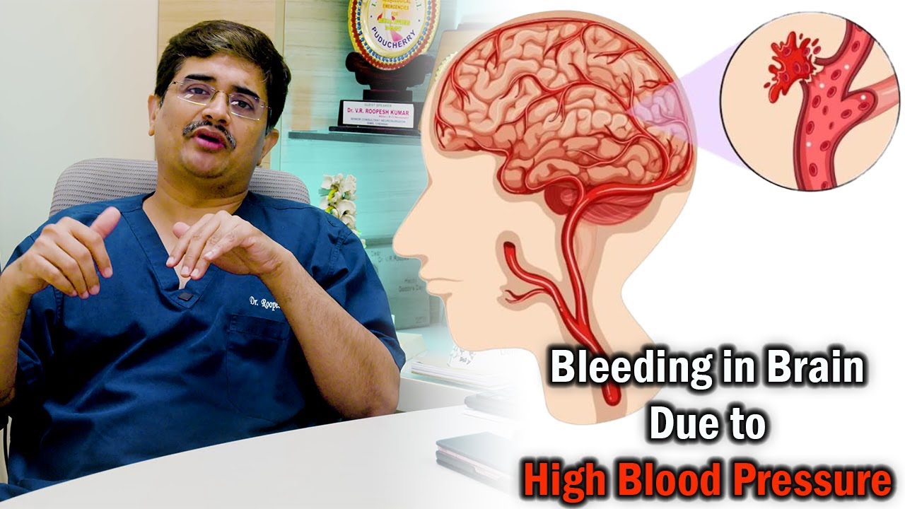 Bleeding in Brain Due to High Blood&nbsp;Pressure Dr.Roopesh Kumar