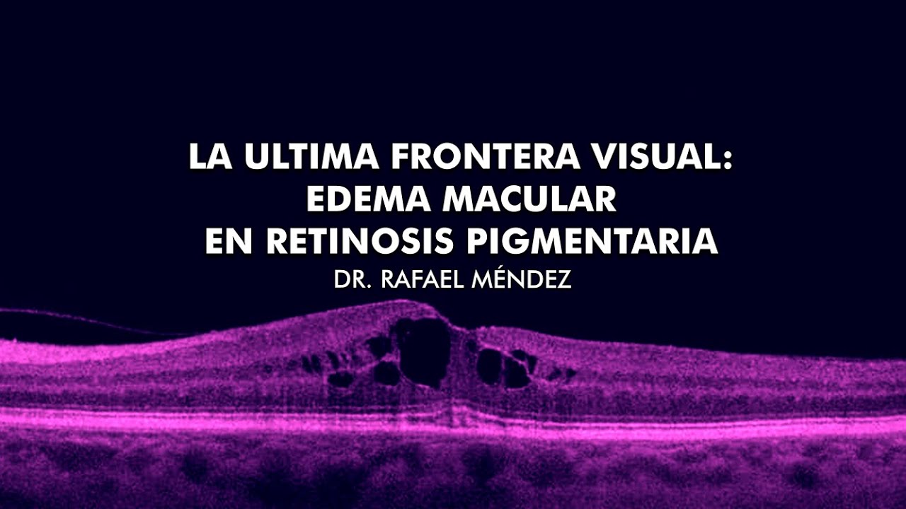La última frontera visual: Edema macular en retinosis pigmentaria - Dr. Rafael Méndez