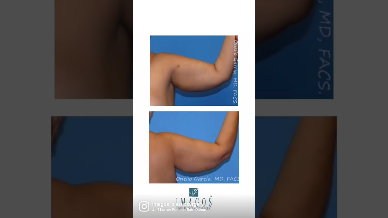 Arm Lift Results | Arm Lift surgery and liposuction before and after