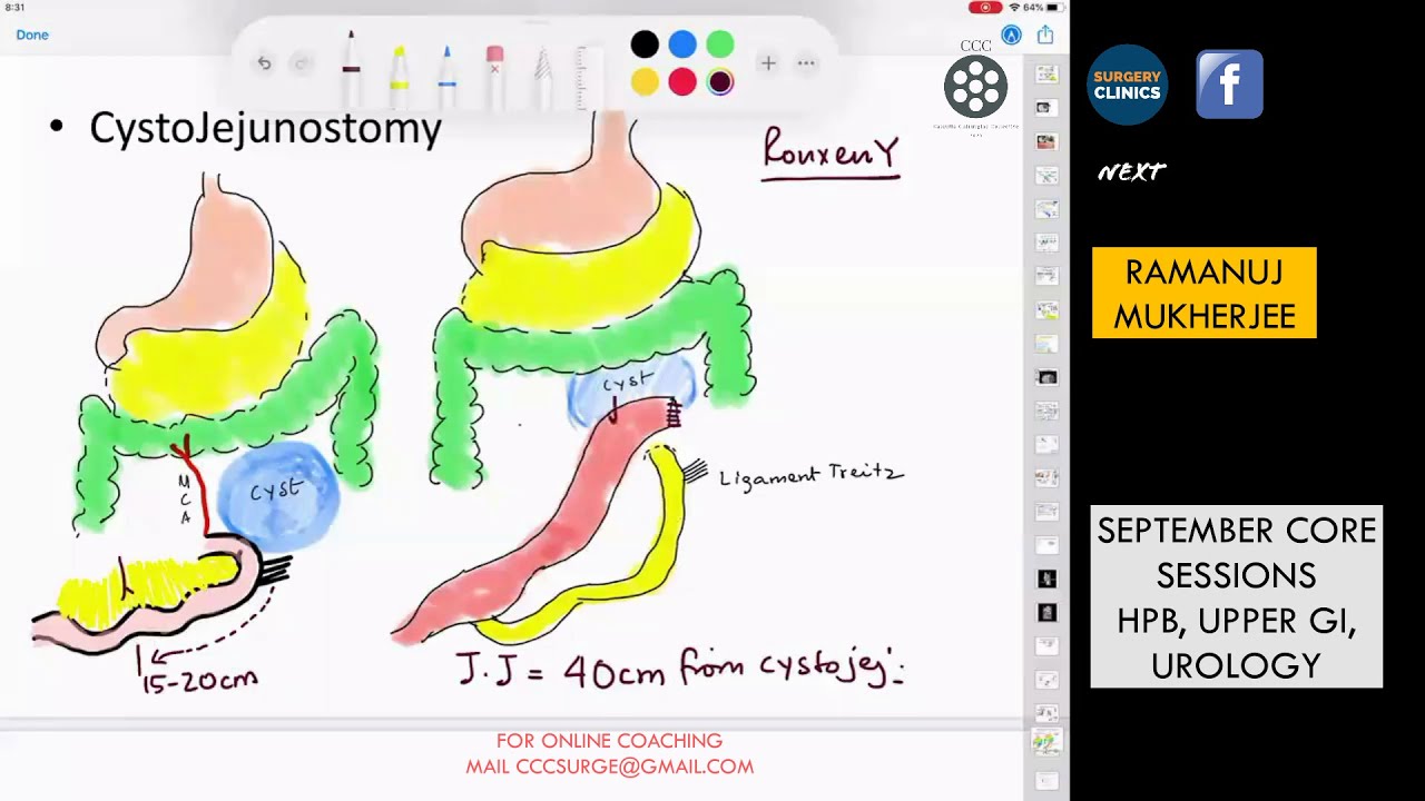 CCC HPB - Surgery for Pancreatic Pseudocyst - Step by step - Ramanuj Mukherjee - 04/09/20 #cccshorts
