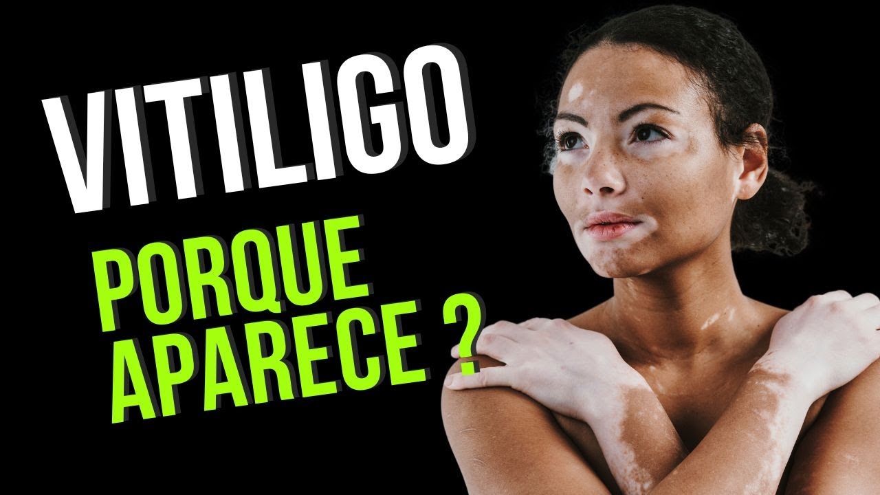 Porque o vitiligo aparece? Será que causa outras coisas além das manchas na pele? Tem tratamento?