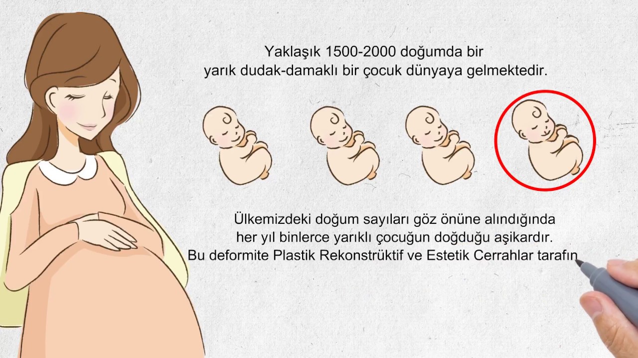 Yarık Dudak Damaklı Çocuklar ve Estetik Cerrahi