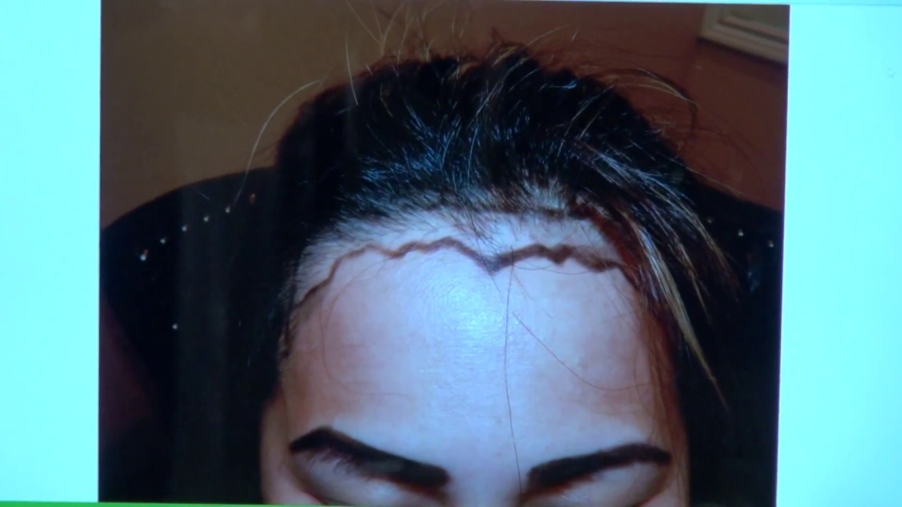 Asian Woman Frontal Hairline Restoration in California by Dr.Diep  
