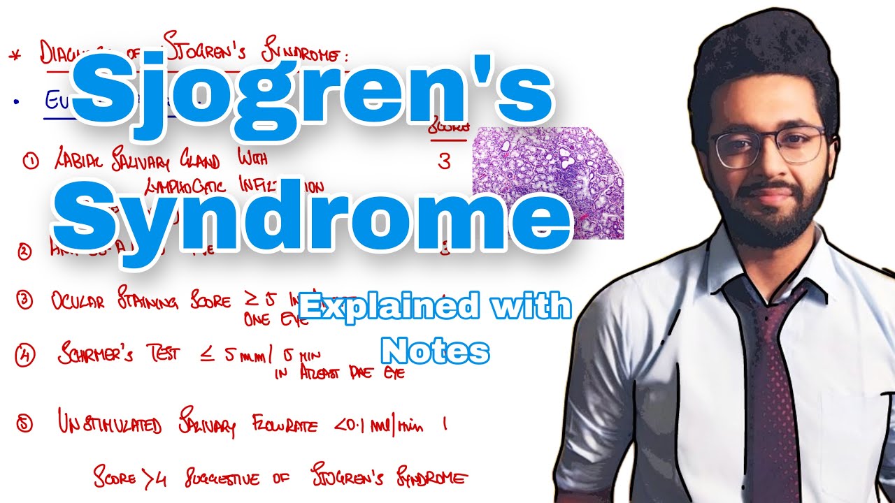 Sjogren’s Syndrome- Etiology,Pathogenesis,Types,Clinical Features,Diagnosis and Management