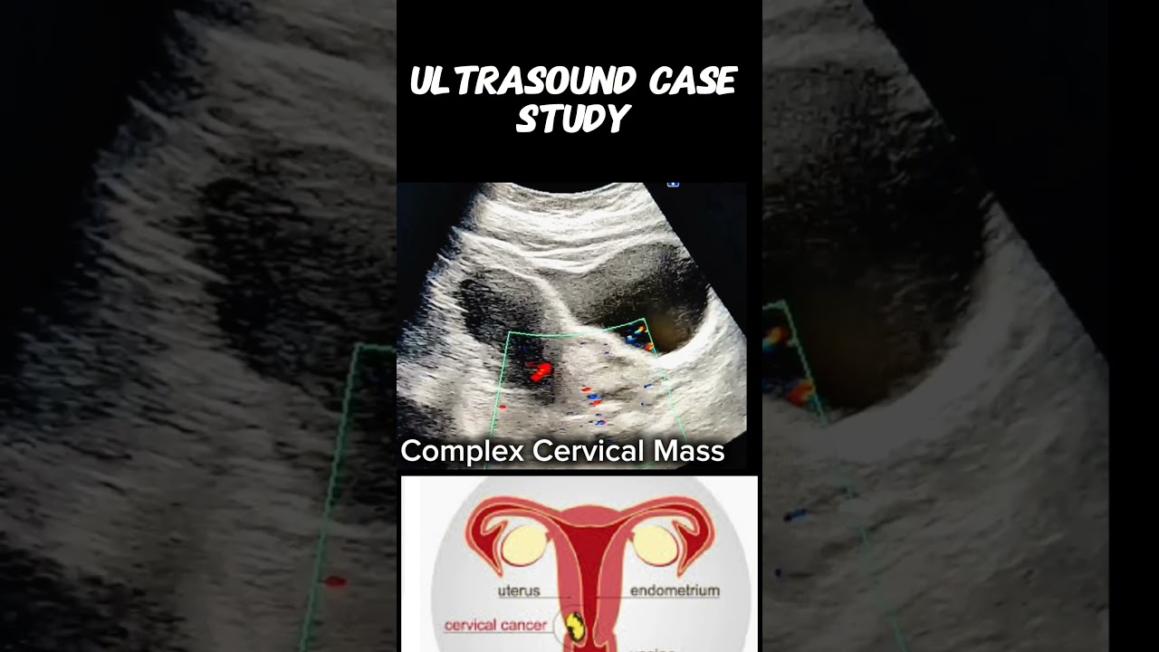 Spotting the Signs: Complex Cervical Mass in Sonography #doctor #ultrasound #health @Dr.SaimaKhan