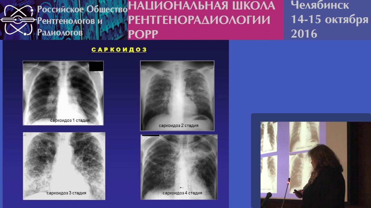 И.А. Соколина - Саркоидоз органов дыхания