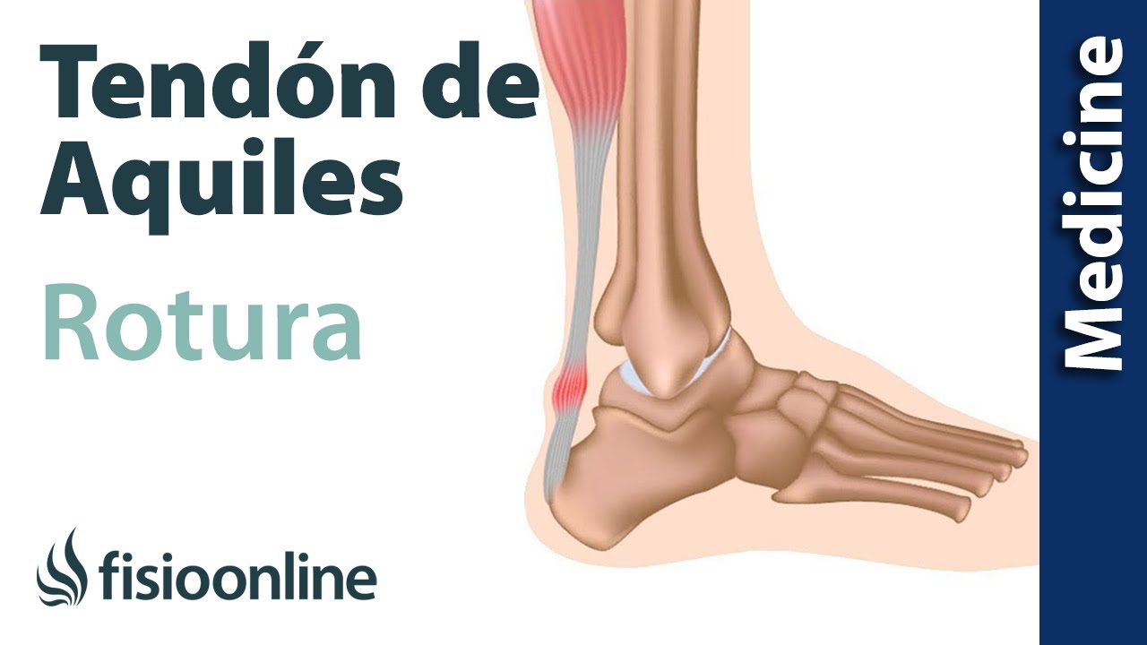 Rotura del tendón de aquiles. Diagnóstico y tratamiento de fisioterapia, médico y quirúrgico