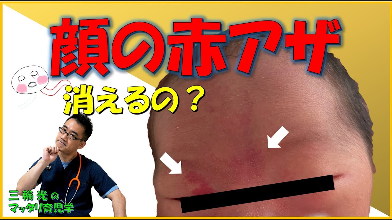 【1か月健診（身体のこと）】顔の赤アザ（サーモンパッチ）って消えるの？