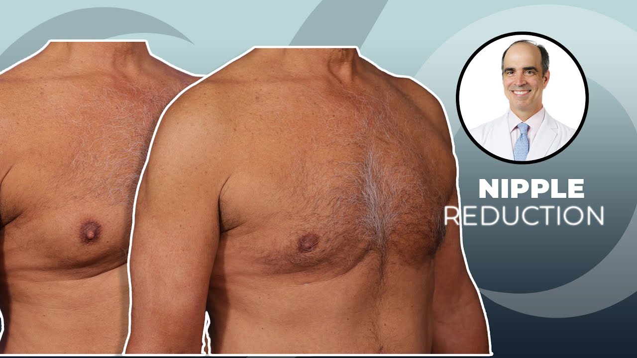Nipple Reduction + Gynecomastia | Dr. David Stoker | Los Angeles, CA