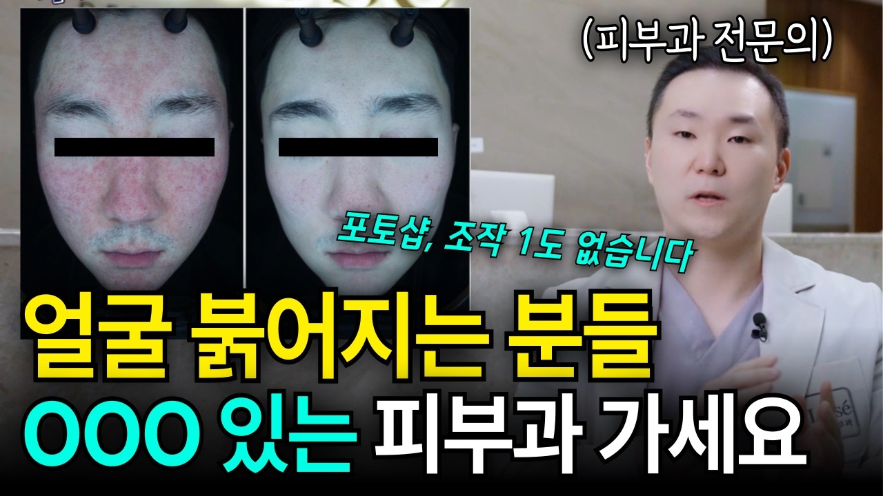 안면홍조 때문에 술 마셨냐는 오해, 언제까지 참으실 건가요? 이렇게 해결할 수 있습니다 [서면피부과, 부산피부왕]