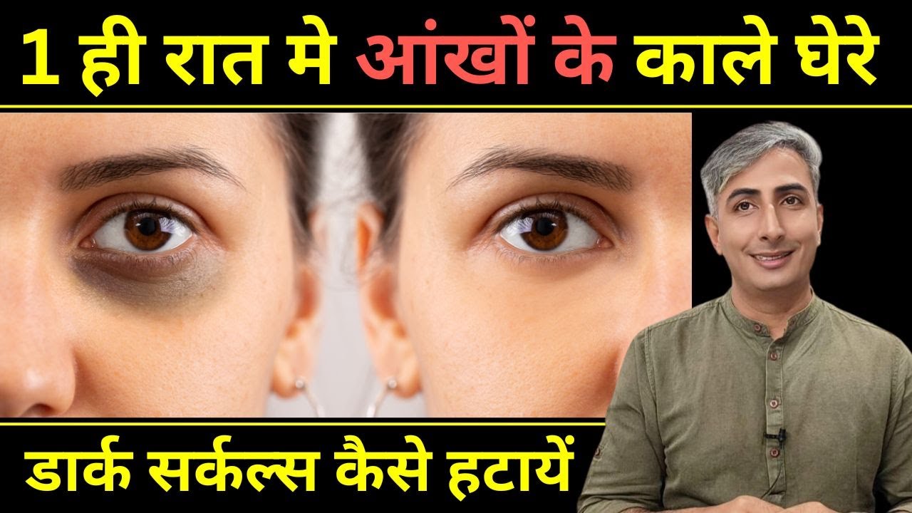 1 ही रात मे आंखों के काले घेरे हटाने के घरेलू नुस्खे | Dark Circles Kaise Hataye I DR, MANOJ DAS