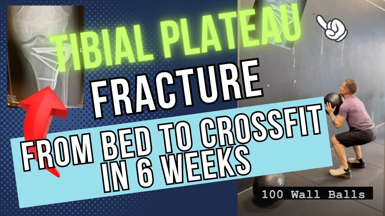 Tibial Plateau Fracture From Bed to Crossfit in 6 Weeks