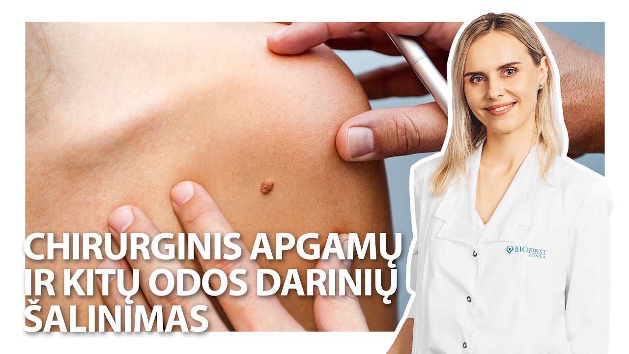 Chirurginis apgamų ir odos darinių šalinimas | Med.m.dr. J. Karčiauskienė