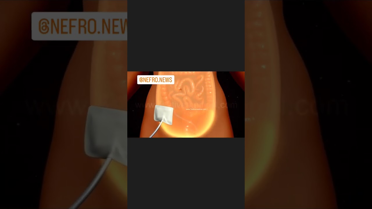 Di&aacute;lise Peritoneal