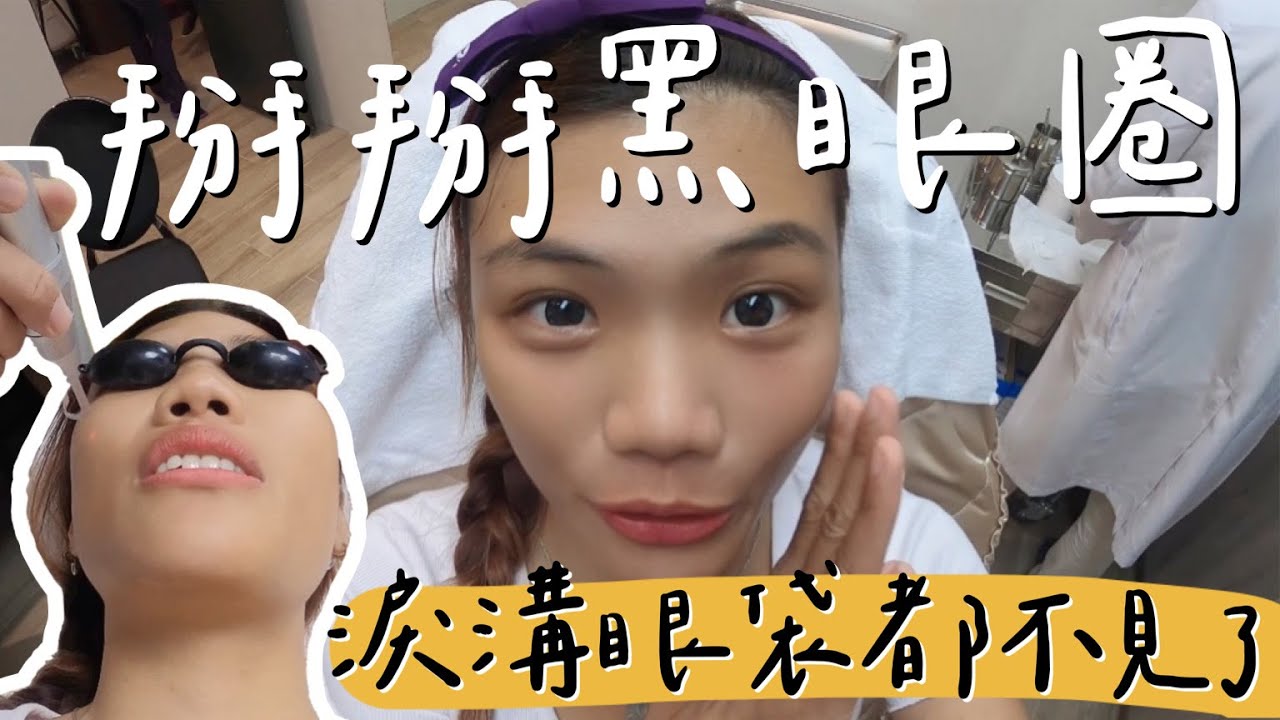 偷偷消除『黑眼圈』.... 三個月後竟然變這樣？困擾多年的黑眼圈掰掰！！淚溝、眼袋也一起再見！