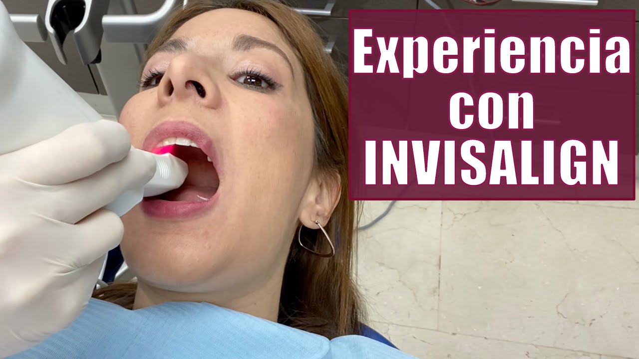 INVISALIGN, experiencia tras 1 año⚠️Lo BUENO y lo MALO!!!