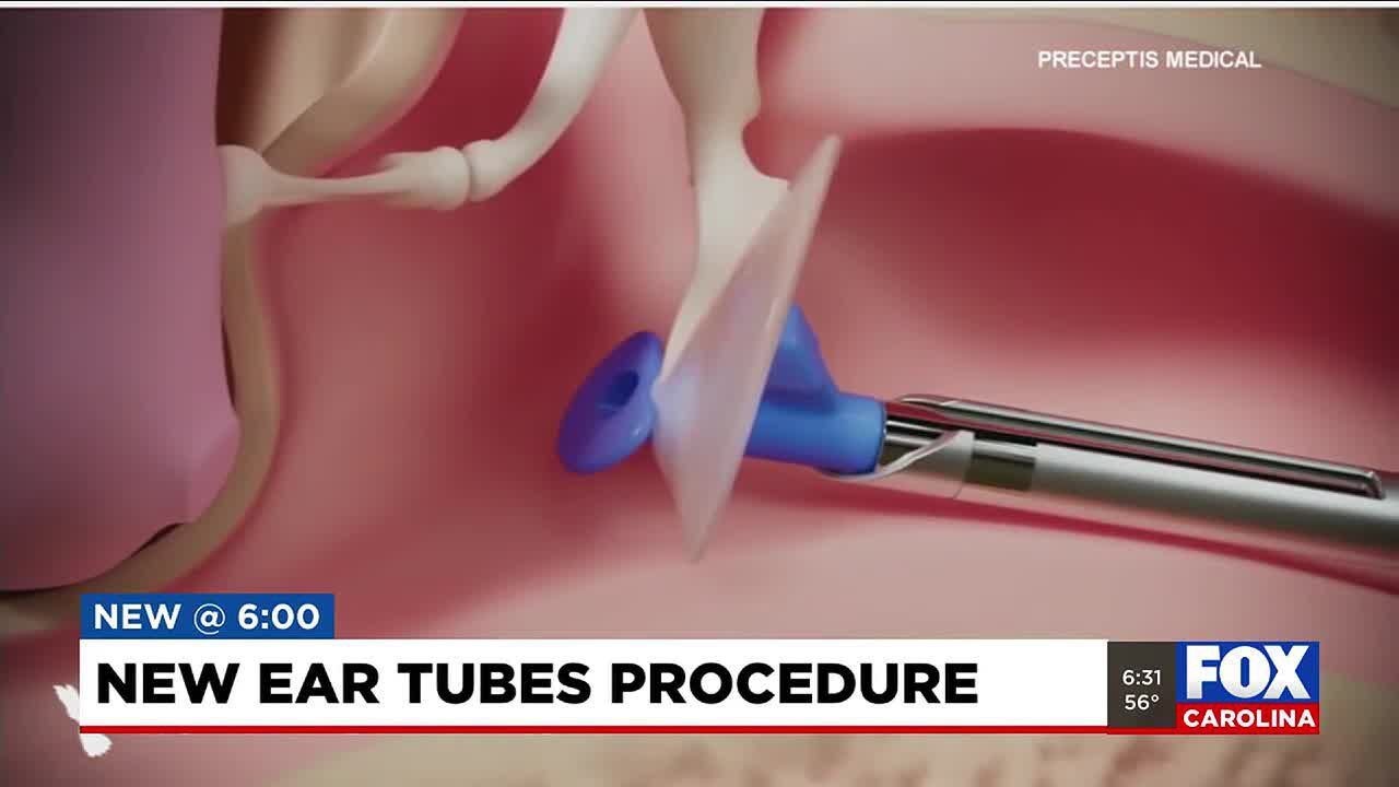 New ear tube procedure changing the game for children with ear infections