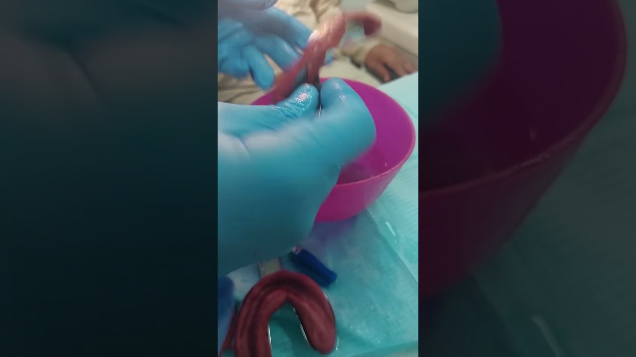 primary impression for complete denture with impression compound (شرح on patient)