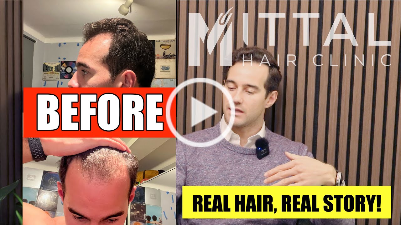 The Truth About Hair Transplants — Cost, Recovery & Confidence | Real Story