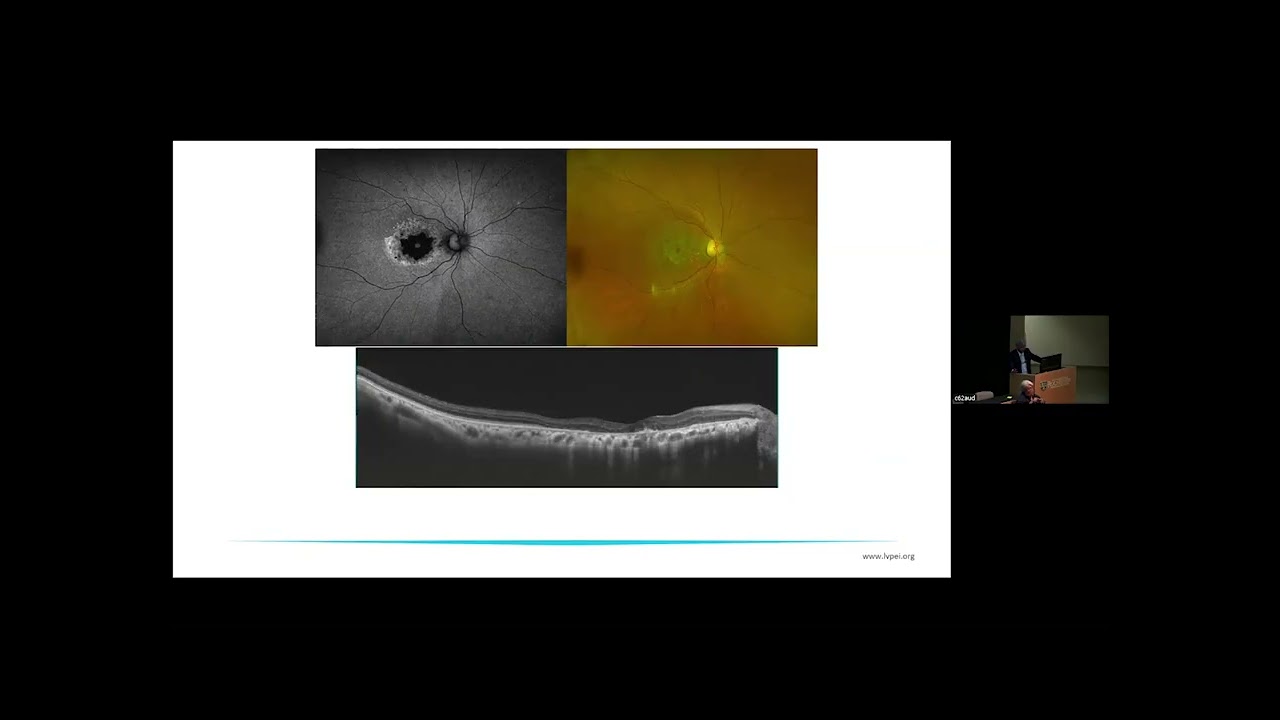 2025 Rochester Ophthamalogy Conference Session 1, Retina